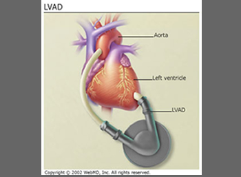 Artificial Hearts